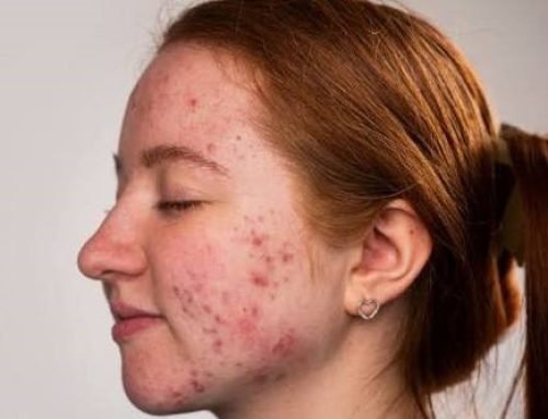 SUS oferece tratamento gratuito para casos graves de acne